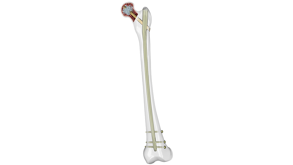 TFNADVANCED™ Proximal Femoral Nailing System (TFNA) Products DePuy